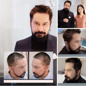 FUE-Haartransplantation Vorher-Nachher-Ergebnisse bei Namninforv Clinic, dichteres Haar