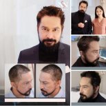 FUE-Haartransplantation Vorher-Nachher-Ergebnisse bei Namninforv Clinic, dichteres Haar