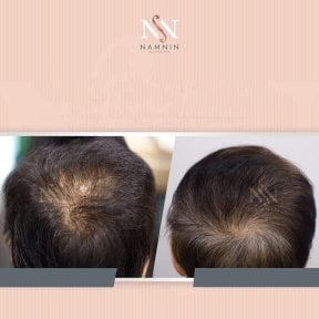 Vorher-nachher-Ergebnisse FUE-Haartransplantation bei Namninforv Clinic, dichteres Haar