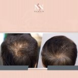 Vorher-nachher-Ergebnisse FUE-Haartransplantation bei Namninforv Clinic, dichteres Haar