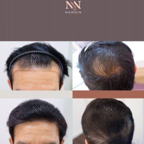 Vorher-nachher-Ergebnisse FUE-Haartransplantation bei Namninforv Clinic, dichteres Haar