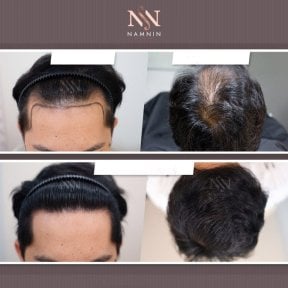 Vorher-nachher-Ergebnisse FUE-Haartransplantation bei Namninforv Clinic, mehr Haardichte
