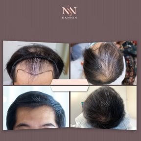 Vorher-nachher-Ergebnisse FUE-Haartransplantation bei Namninforv Clinic mit vollerem Haar