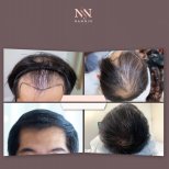 Vorher-nachher-Ergebnisse FUE-Haartransplantation bei Namninforv Clinic mit vollerem Haar