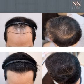 Vorher-nachher-Ergebnis FUE-Haartransplantation bei Namninforv Clinic, dichteres Haar
