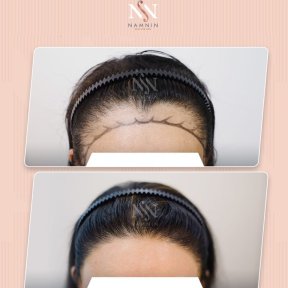 FUE-Haartransplantation Vorher-Nachher-Ergebnis bei Namninforv Clinic, dichtere Haarlinie