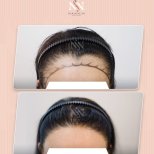 FUE-Haartransplantation Vorher-Nachher-Ergebnis bei Namninforv Clinic, dichtere Haarlinie