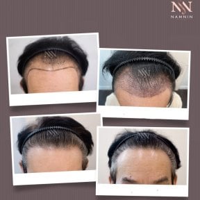 Vorher-nachher-Ergebnisse FUE-Haartransplantation bei Namninforv Clinic, Haaransatz wiederhergestellt