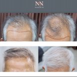 Vorher-nachher-Ergebnisse FUE-Haartransplantation bei Namninforv Clinic, mehr Haardichte