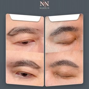 Vorher-nachher-Ergebnis der Blepharoplastik bei Namninforv Clinic, Lidstraffung für Jugendlichkeit