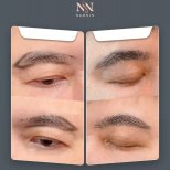 Vorher-nachher-Ergebnis der Blepharoplastik bei Namninforv Clinic, Lidstraffung für Jugendlichkeit