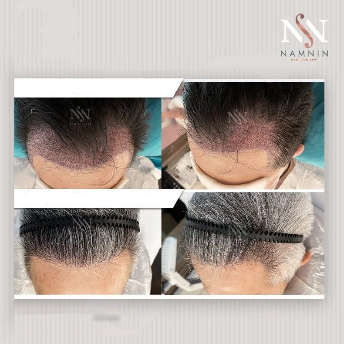 نتائج زراعة الشعر FUE قبل وبعد في عيادة Namninforv، استعادة خط الشعر للرجال