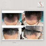 Vorher-nachher-Ergebnisse FUE-Haartransplantation bei Namninforv Clinic, Haaransatz wiederhergestellt