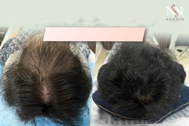 Vorher-nachher-Ergebnis FUE-Haartransplantation bei Namninforv Clinic, dichteres Haar