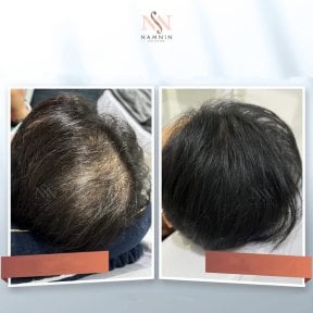 Vorher-nachher-Ergebnis FUE-Haartransplantation bei Namninforv Clinic, dichteres Haar