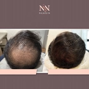 Vorher-nachher-Ergebnis FUE-Haartransplantation bei Namninforv Clinic, dichteres Haar
