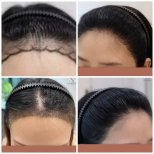 Vorher-nachher-Ergebnisse FUE-Haartransplantation bei Namninforv Clinic, dichtere Haarlinie
