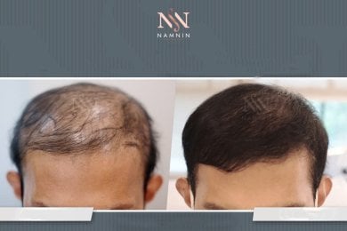Vorher-nachher-Ergebnis FUE-Haartransplantation bei Namninforv Clinic, Haaransatz wiederhergestellt
