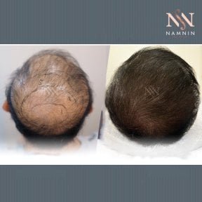Vorher-nachher-Ergebnis FUE-Haartransplantation bei Namninforv Clinic, dichteres Haar