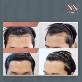 Vorher-nachher-Ergebnisse FUE-Haartransplantation bei Namninforv Clinic, dichtere Haarlinie