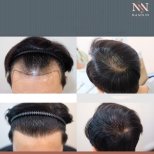 Vorher-nachher-Ergebnisse FUE-Haartransplantation bei Namninforv Clinic, dichteres Haar