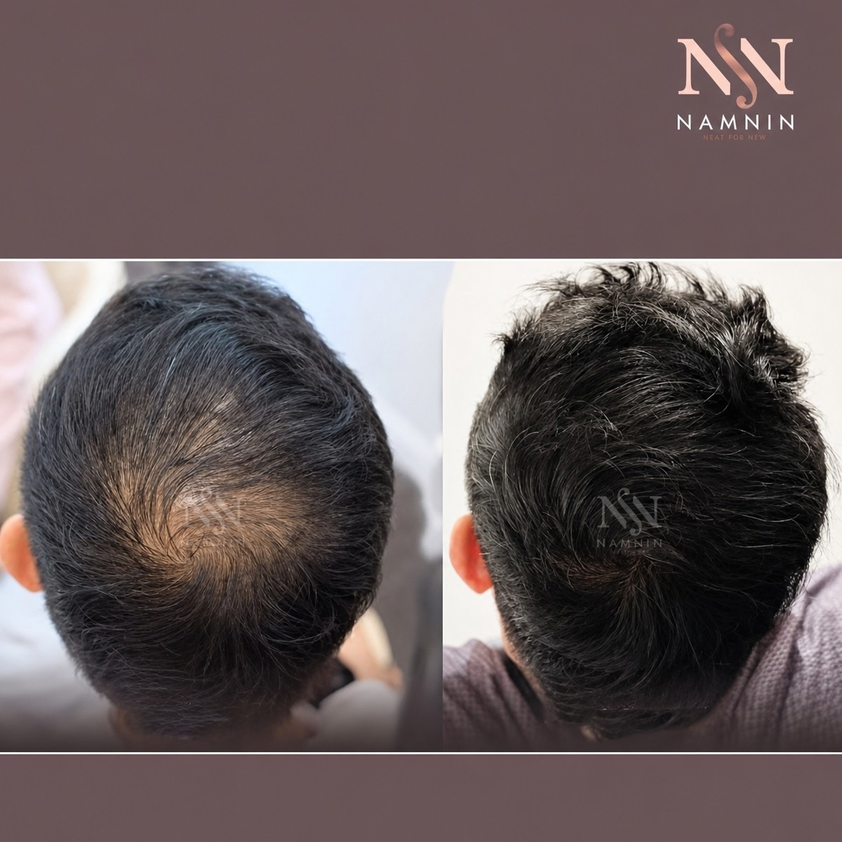 نتائج زراعة الشعر FUE قبل وبعد في عيادة Namninforv، كثافة شعر محسنة