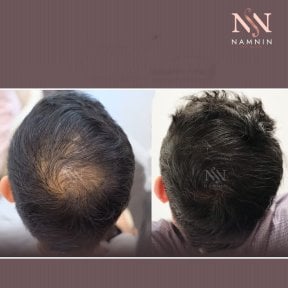 Vorher-nachher-Ergebnis FUE-Haartransplantation bei Namninforv Clinic, dichteres Haar