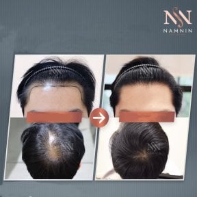 Vorher-nachher-Ergebnisse FUE-Haartransplantation bei Namninforv Clinic, dichteres Haar