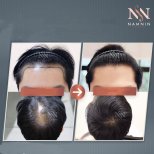 Vorher-nachher-Ergebnisse FUE-Haartransplantation bei Namninforv Clinic, dichteres Haar