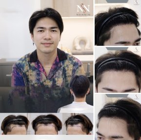 FUE-Haartransplantationsergebnisse bei Namninforv Clinic – dichtere Haarlinie bei Mann