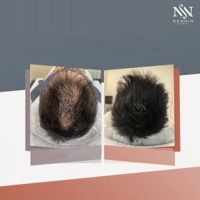 Vorher-nachher-Ergebnis FUE-Haartransplantation bei Namninforv Clinic, dichteres Haar