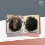 Vorher-nachher-Ergebnis FUE-Haartransplantation bei Namninforv Clinic, dichteres Haar