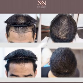 Vorher-nachher-Ergebnisse FUE-Haartransplantation bei Namninforv Clinic, dichteres Haar