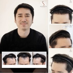 FUE-Haartransplantationsergebnis bei Namninforv Clinic – verbesserter Haaransatz