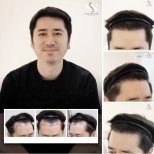 FUE-Haartransplantationsergebnis bei Namninforv Clinic – verbesserter Haaransatz