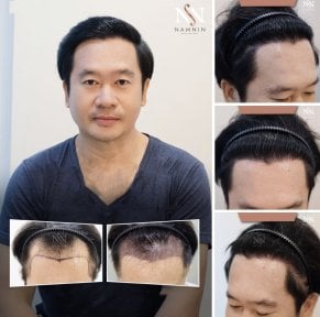 FUE-Haartransplantation Vorher-Nachher-Ergebnisse bei Namninforv Clinic, dichtere Haarlinie