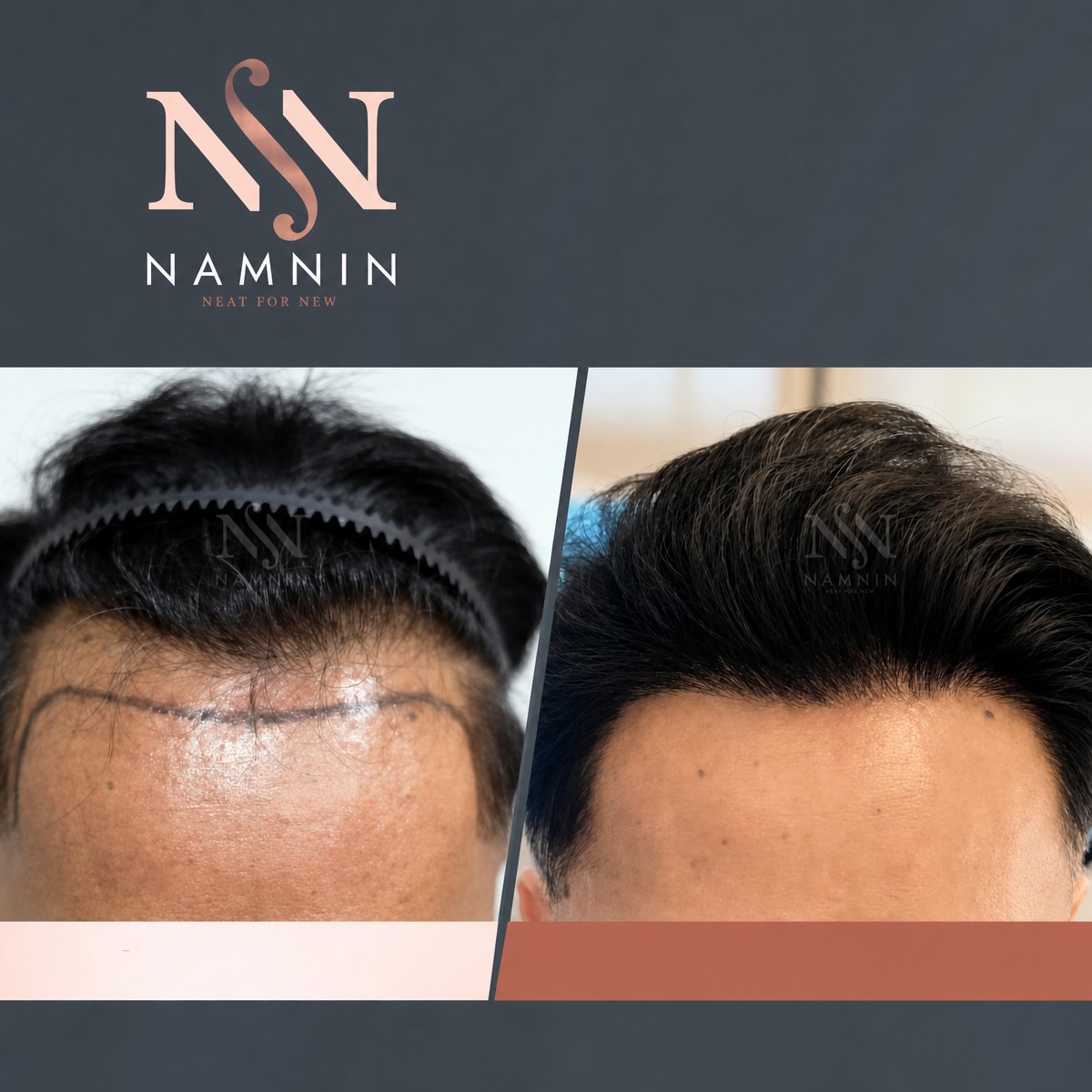 نتائج زراعة الشعر FUE قبل وبعد في عيادة Namninforv، استعادة خط الشعر