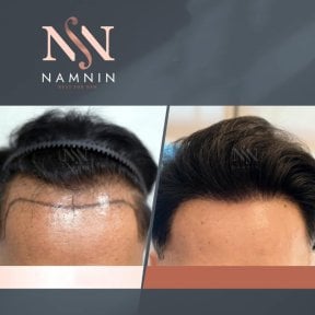 Vorher-nachher-Ergebnis FUE-Haartransplantation bei Namninforv Clinic, Haaransatz erneuert
