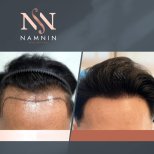 Vorher-nachher-Ergebnis FUE-Haartransplantation bei Namninforv Clinic, Haaransatz erneuert