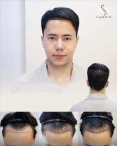 FUE-Haartransplantation Vorher-Nachher-Ergebnisse bei Namninforv Clinic, dichtere Haarlinie