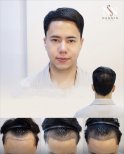 FUE-Haartransplantation Vorher-Nachher-Ergebnisse bei Namninforv Clinic, dichtere Haarlinie