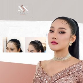 FUE-Haartransplantation Vorher-Nachher-Ergebnisse bei Namninforv Clinic, verbesserter Haaransatz