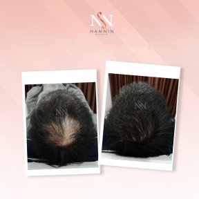 Vorher-nachher-Ergebnis FUE-Haartransplantation bei Namninforv Clinic, dichteres Haar