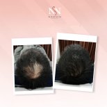 Vorher-nachher-Ergebnis FUE-Haartransplantation bei Namninforv Clinic, dichteres Haar