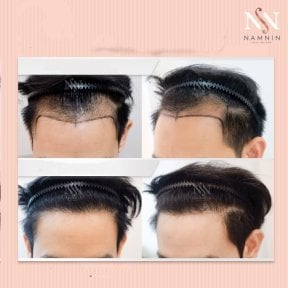Vorher-nachher-Ergebnisse FUE-Haartransplantation bei Namninforv Clinic, verbesserte Haarlinie