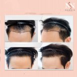 Vorher-nachher-Ergebnisse FUE-Haartransplantation bei Namninforv Clinic, verbesserte Haarlinie