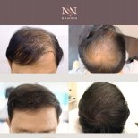 Vorher-nachher-Ergebnisse FUE-Haartransplantation bei Namninforv Clinic, dichteres Haar