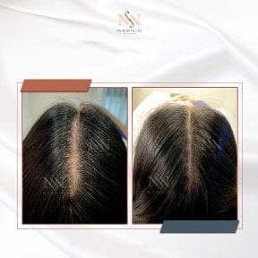 Vorher-nachher FUE-Haartransplantation bei Namninforv Clinic, sichtbare Haardichte-Verbesserung