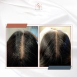 Vorher-nachher FUE-Haartransplantation bei Namninforv Clinic, sichtbare Haardichte-Verbesserung
