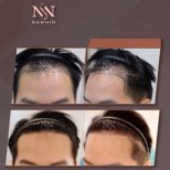 Vorher-nachher-Ergebnisse FUE-Haartransplantation bei Namninforv Clinic, dichtere Haarlinie